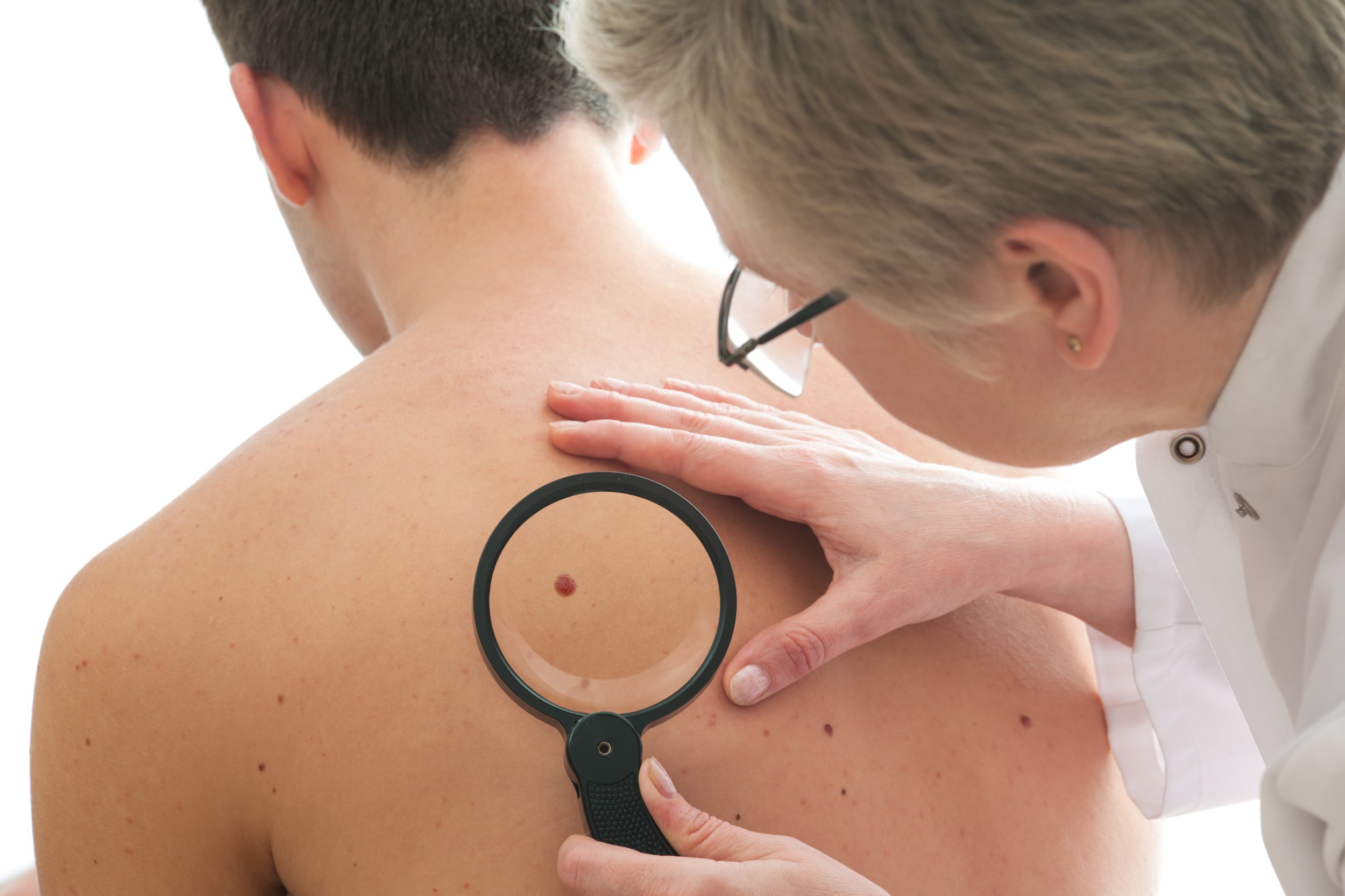 População surda recebe orientação sobre câncer de pele e cuidados com raios solares